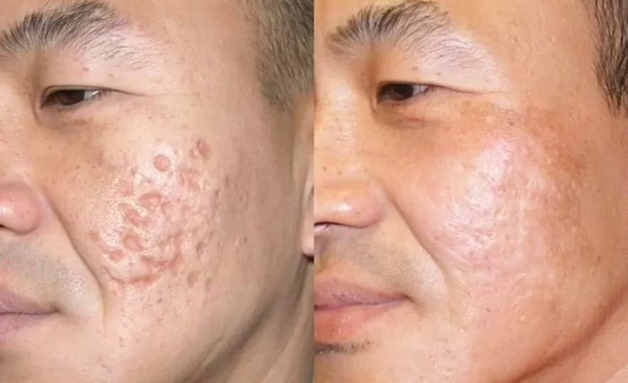 Microagulhamento para Cicatriz de Acne Antes e Depois