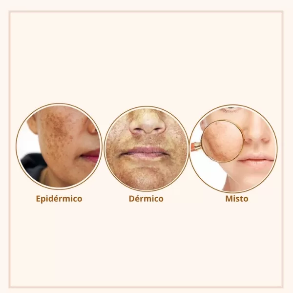 Tipos de Melasma